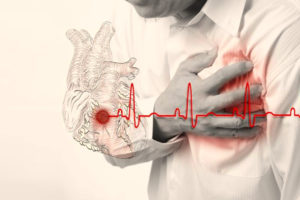 симптомы инфаркта миокарда фото