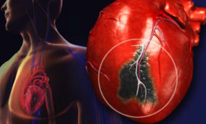 симптомы инфаркта миокарда фото